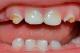 La Caries Dental en Niños de 1 a 3 Años
