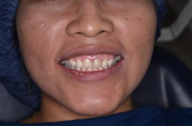 Rehabilitación con carillas dentales